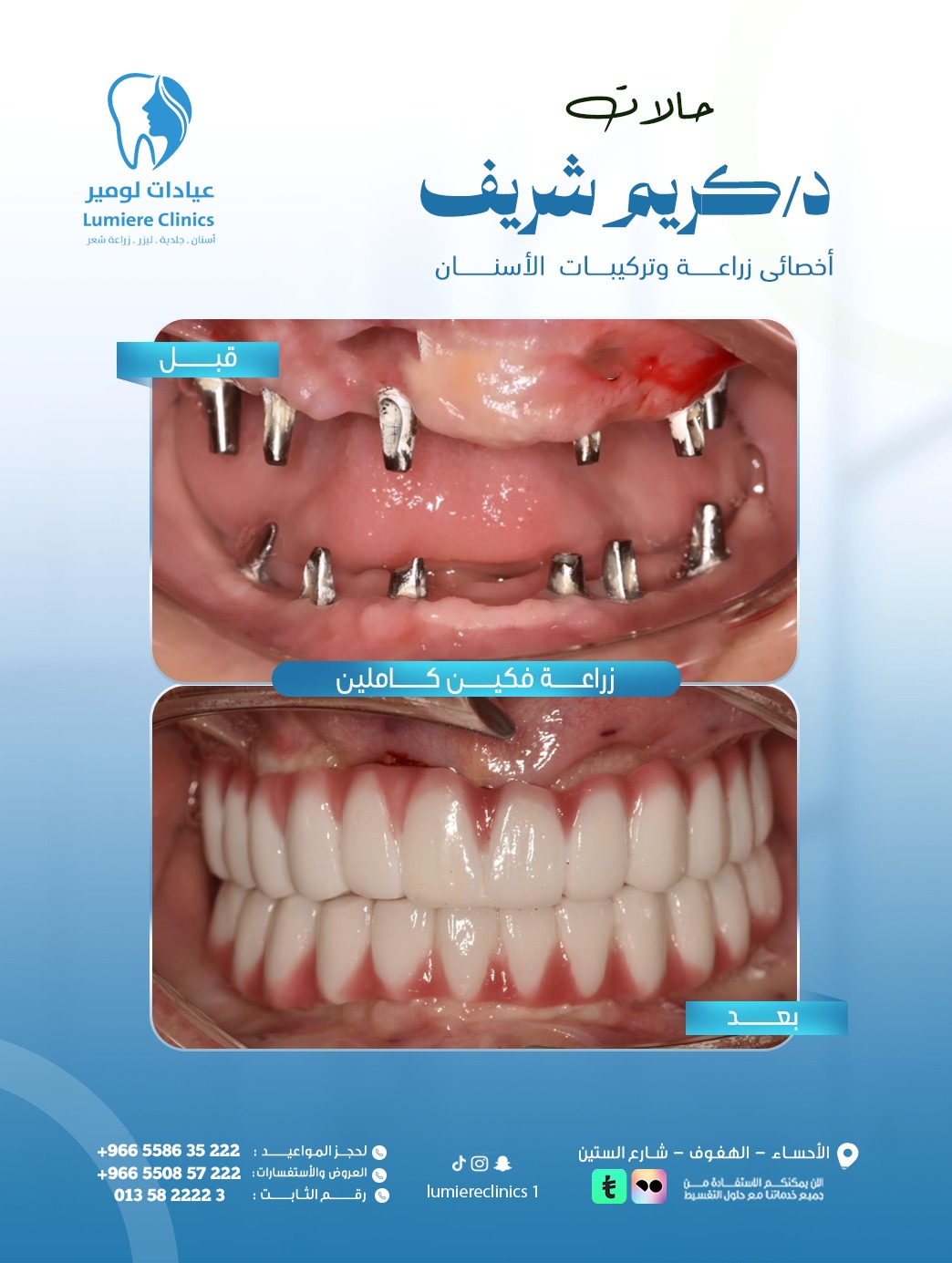 زراعة أسنان