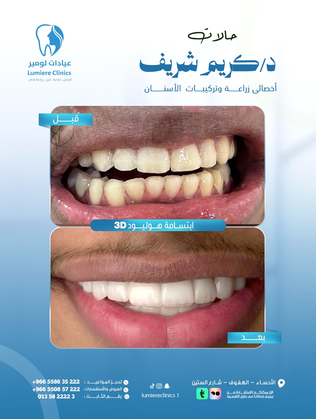 ابتسامة هوليود — حالة 2