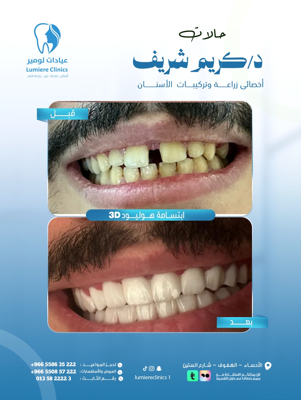 ابتسامة هوليود — حالة 3