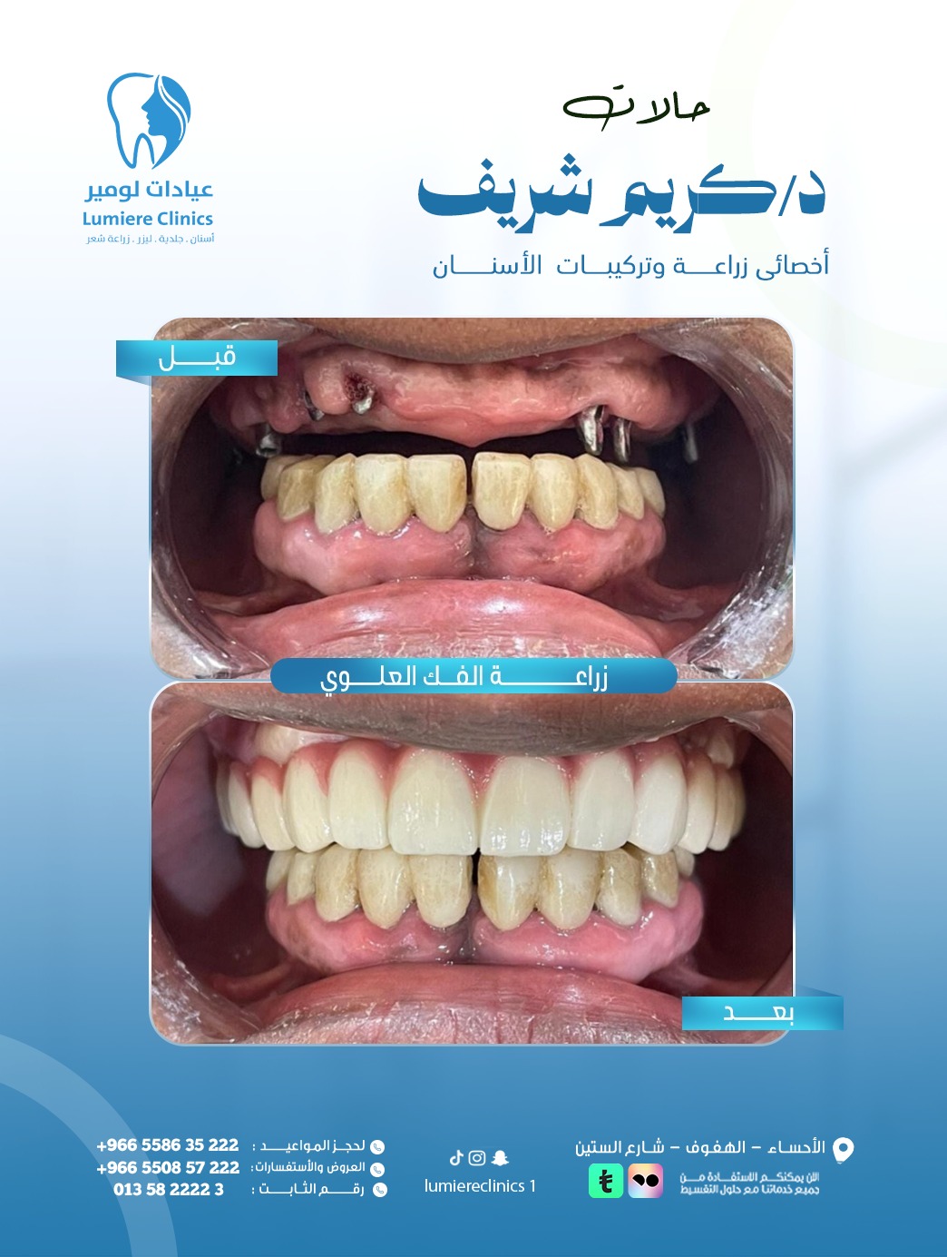 زراعة فك علوي