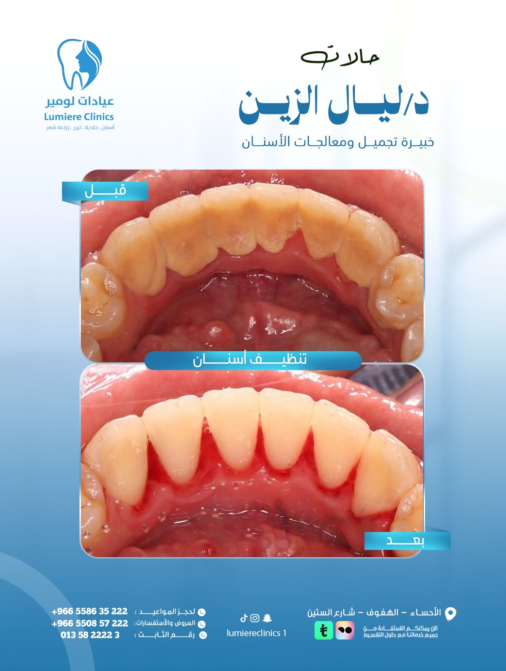 تنظيف وتلميع الأسنان
