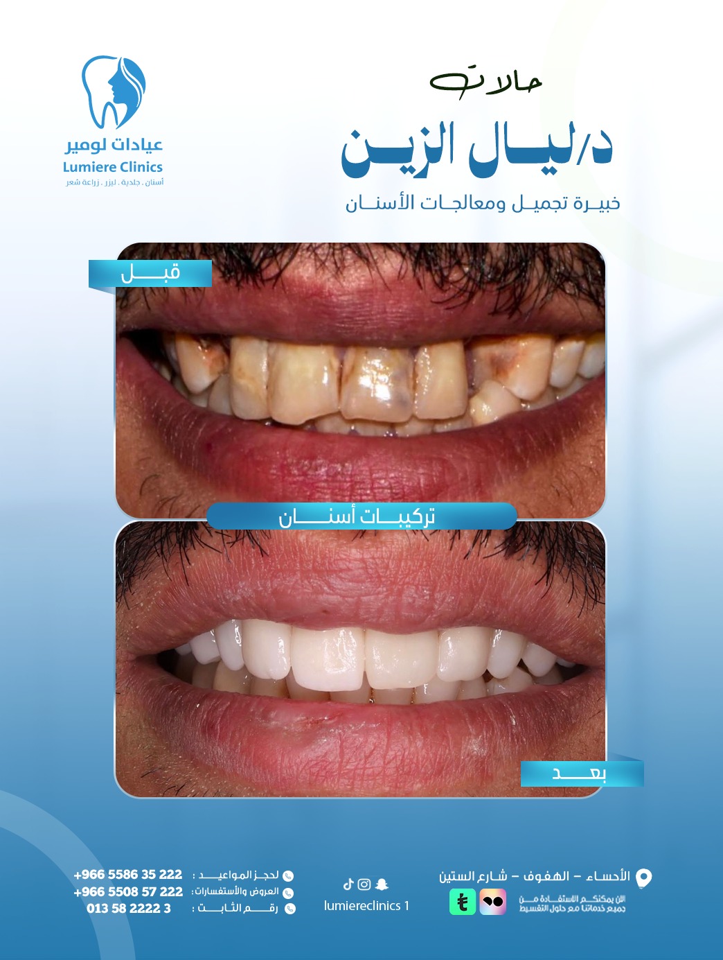 طب وتجميل الأسنان — تيجان خزفية