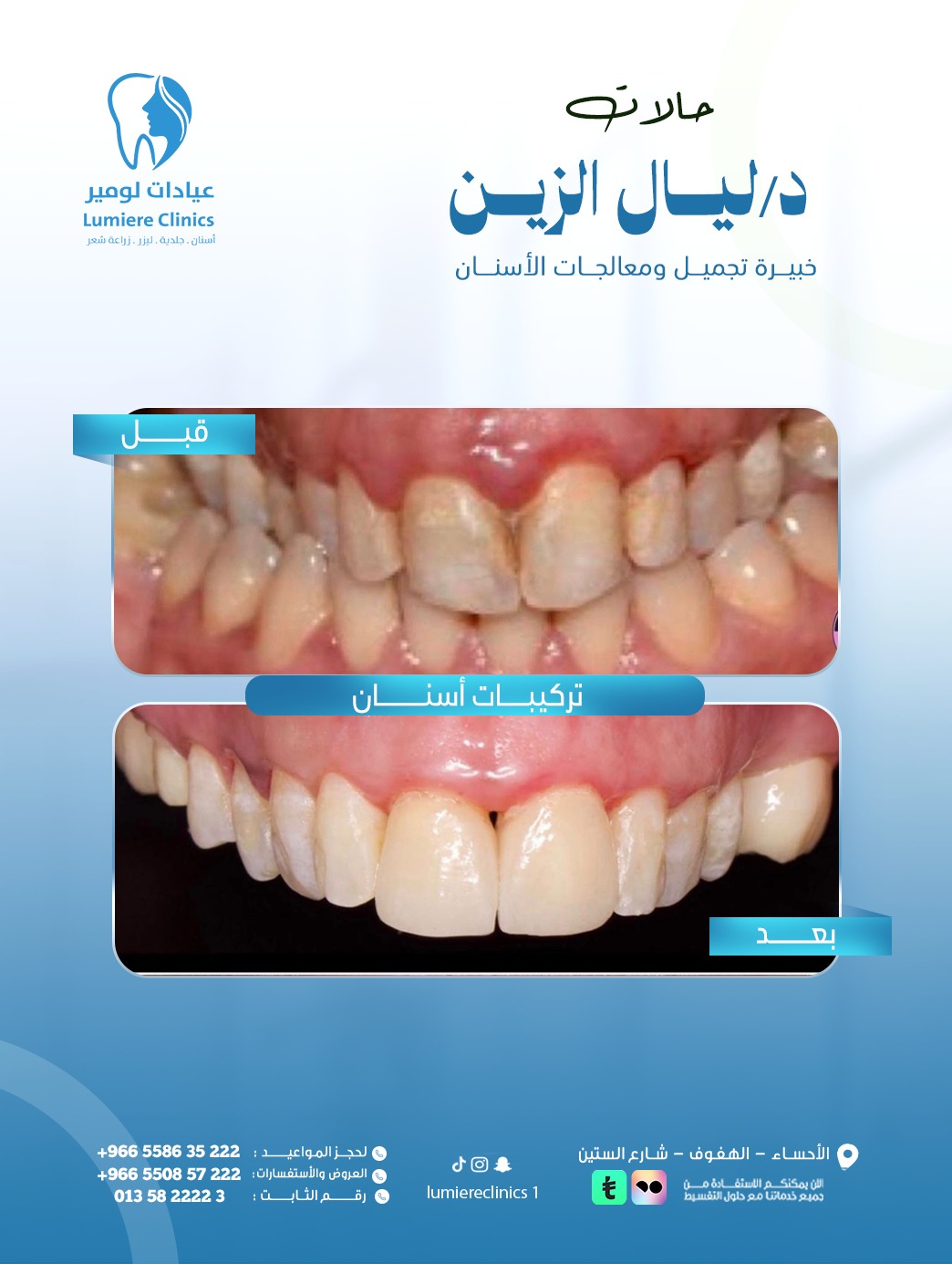 تيجان خزفية — حالة 2