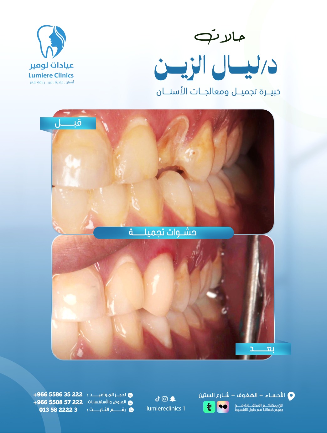 حشوات تجميلية