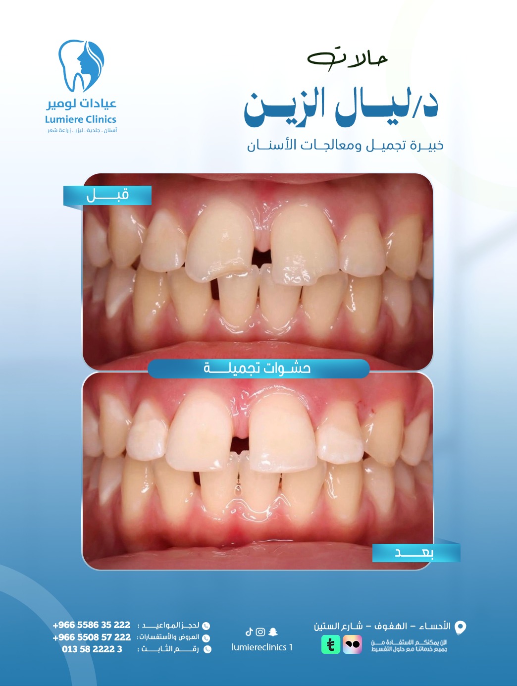 حشوات أمامية