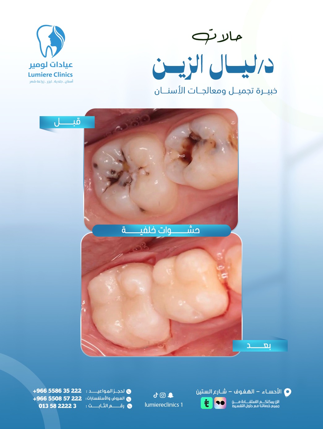 حشوات خلفية